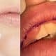 Lip Fillers