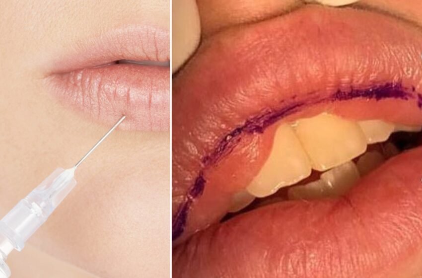  Lip Fillers Gone Wrong? Basic Things To Know!