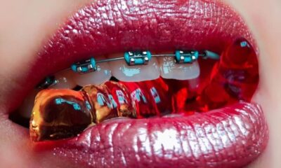 Best Braces Color for Your Teeth
