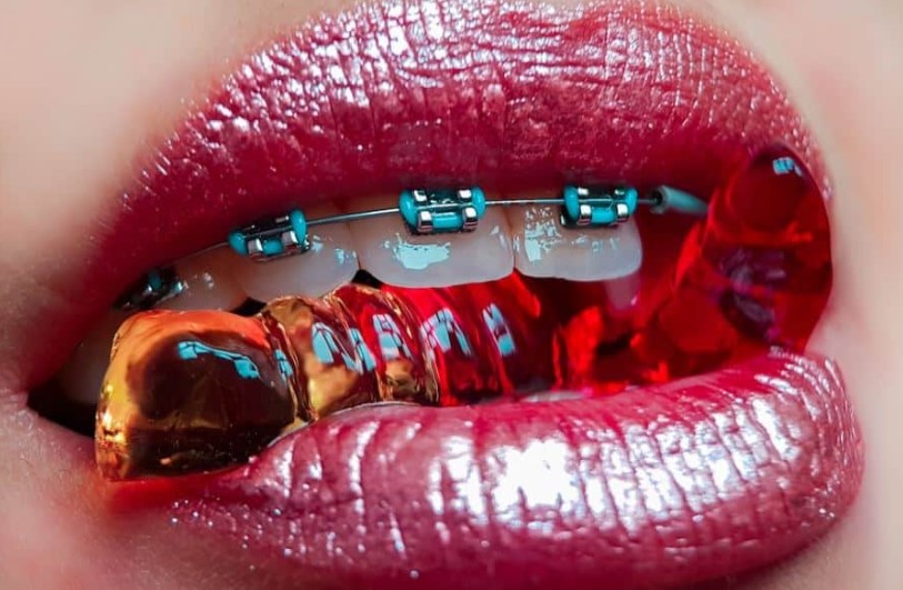 Best Braces Color for Your Teeth