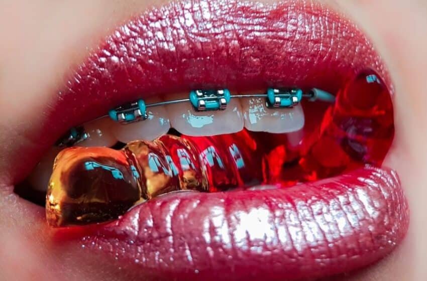 Braces Color for Your Teeth