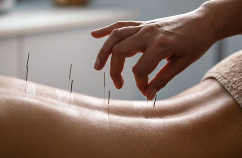 Acupuncture