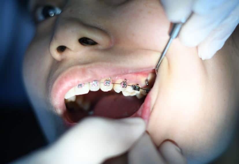 Reapplication of Braces