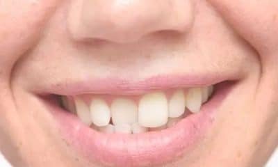 Shifted Teeth