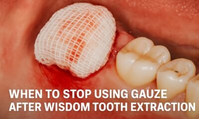 When to Stop Using Gauze After Wisdom Tooth Extraction