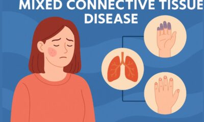 Mixed Connective Tissue Disease