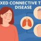 Mixed Connective Tissue Disease