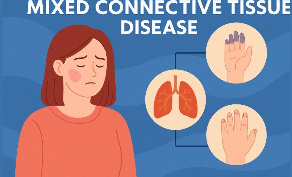 Mixed Connective Tissue Disease