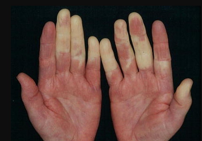 Mixed Connective Tissue Disease hands